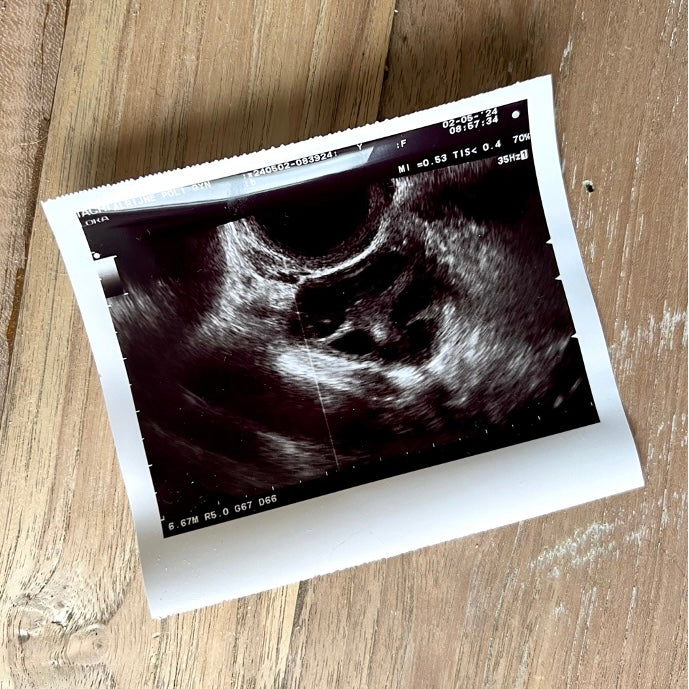 2e IUI (Intra-Uteriene inseminatie) (deel 6)